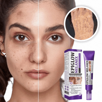 Lunoria® PigmentGel™ | Minskar mörka fläckar med upp till 93 % – på bara 3 nätter!